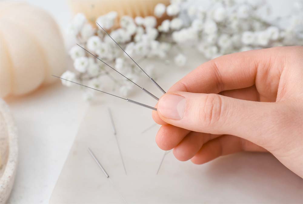 Main tenant des aiguilles d'acupuncture, une méthode douce envisagée par les femmes enceintes pour une gestion de la douleur pendant un accouchement physiologique.