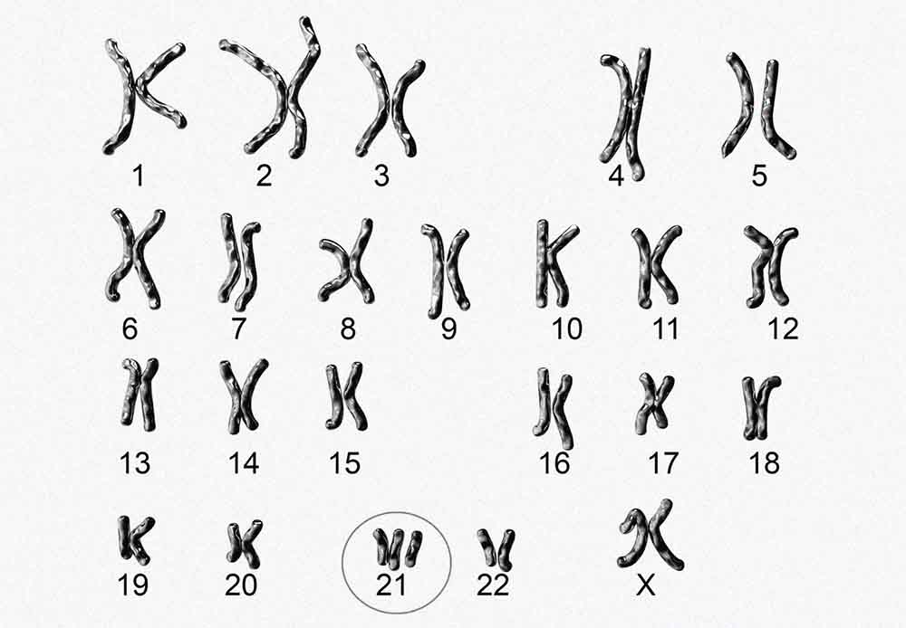 Analyse du caryotype pour le dépistage prénatal : un outil fondamental pour détecter les anomalies chromosomiques telles que la trisomie. Chromosome 21.