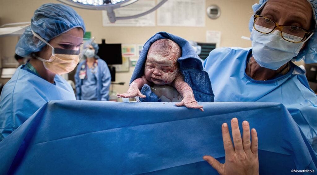 Accouchement par césarienne en salle d’opération, naissance au bloc, comment se passe une césarienne programmée, bébé extrait sous champ stérile, naissance bébé au bloc opératoire, déroulé opération césarienne