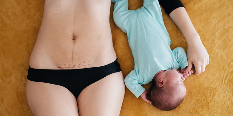 Corps après accouchement par césarienne, cicatrice post-op visible, réalité postpartum après opération, bébé couché près de sa mère, cicatrice après césarienne, récupération post-op accouchement, traces corporelles après accouchement par césarienne, réalité corps post-naissance
